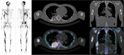 A novel approach for fibrous dysplasia assessment using combined planar and quantitative SPECT/CT analysis of Tc-99m-diphosphonate bone scan in correlation with biological bone turnover markers of disease activity